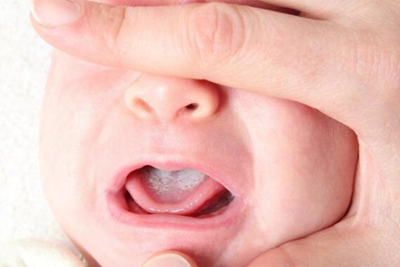 婴儿舌苔厚白是怎么回事？这五个原因宝妈及时治疗改善