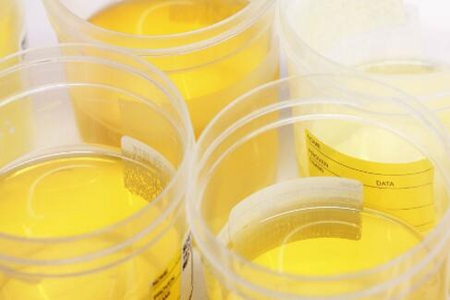 尿液发黄是什么原因？（这五个原因早发现早治疗）